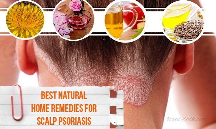 Home Remedies For Scalp Psoriasis