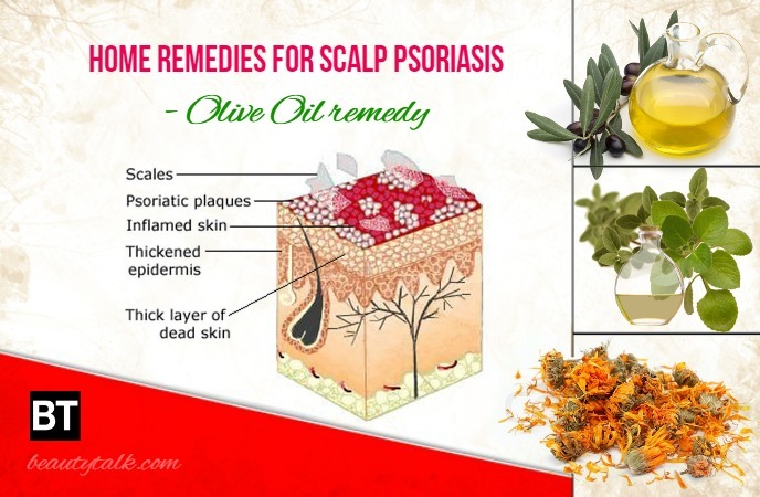 Home Remedies For Scalp Psoriasis 