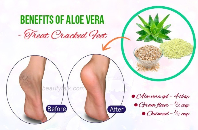 aloe vera gel for cracked heels