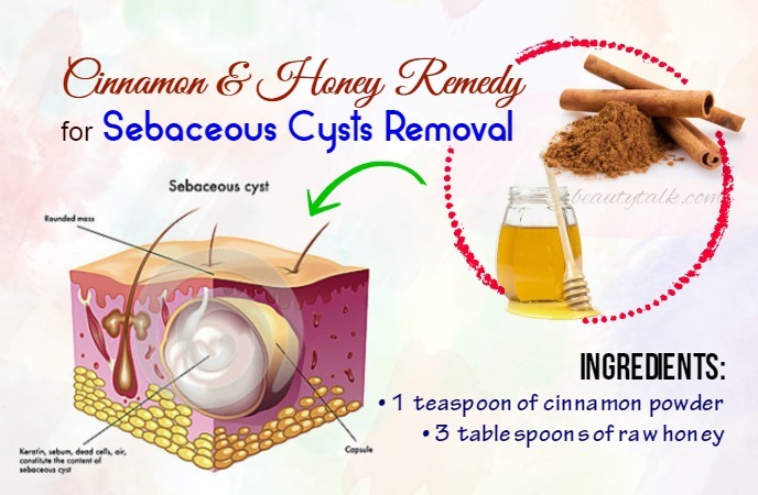 15-remedies-on-how-to-get-rid-of-sebaceous-cysts-naturally