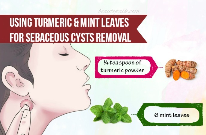 15-remedies-on-how-to-get-rid-of-sebaceous-cysts-naturally