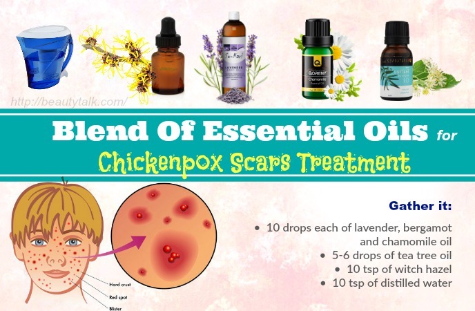 How To Get Rid Of Chickenpox Scars 