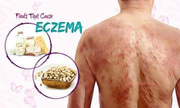 foods that cause eczema