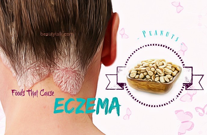 foods that cause eczema 