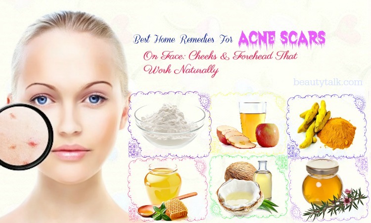 home remedies for acne scars on face