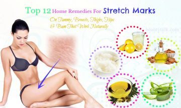 home remedies for stretch marks on breasts