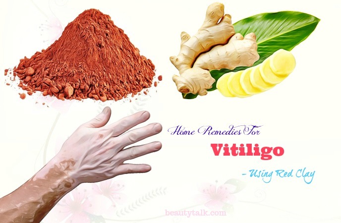 home remedies for vitiligo on hands - vitiligo using red clay