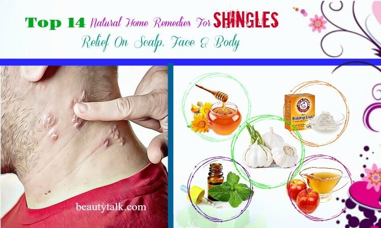 home remedies for shingles on scalp