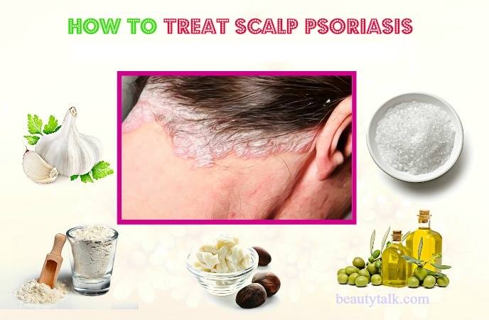 scalp psoriasis