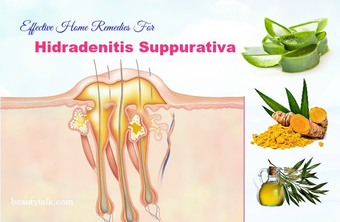 home remedies for hidradenitis suppurativa