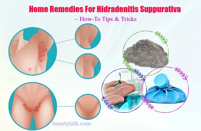 home remedies for hidradenitis suppurativa – how-to tips & tricks