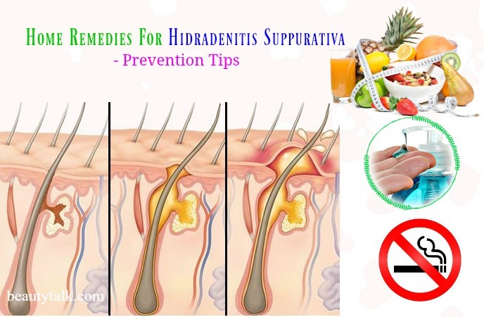 home remedies for hidradenitis suppurativa - prevention tips