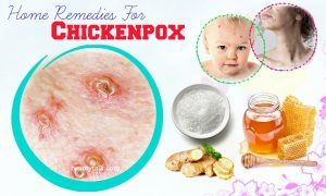 16 Proven Home Remedies For Chickenpox In Children & Adults