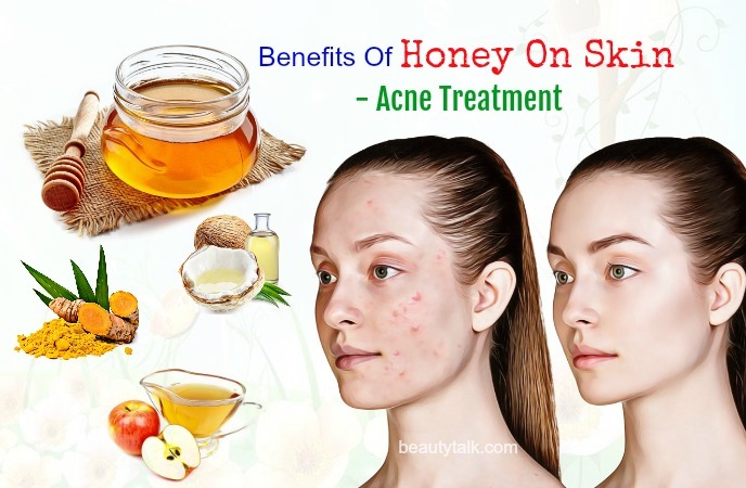 acne treatment