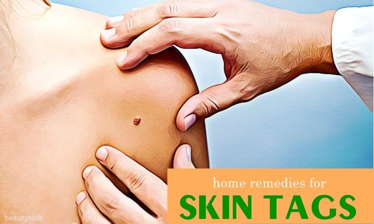 13 Natural Home Remedies For Skin Tags On Face And Neck