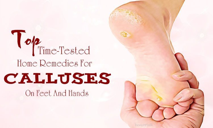 home remedies for calluses on feet