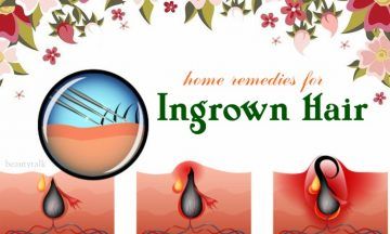 home remedies for ingrown hair on buttocks